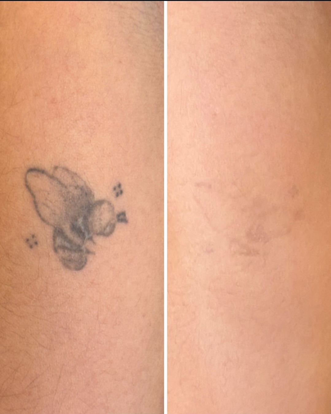 Before and after of a bee tattoo on the arm, fully faded with saline removal