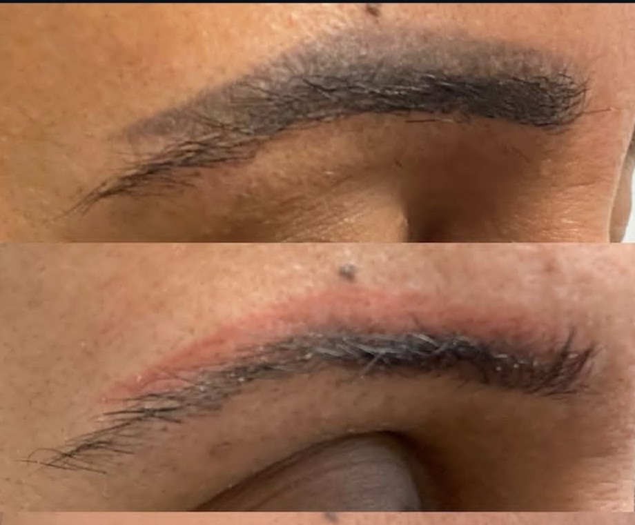 Before and after of eyebrow PMU faded with saline removal