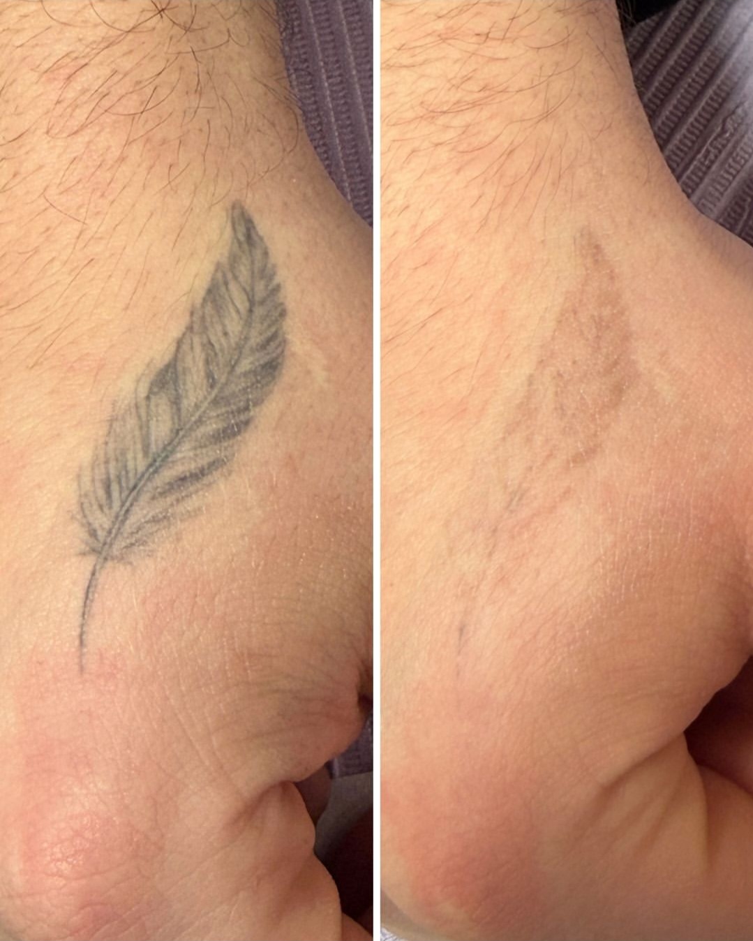 Before and after of a feather tattoo on the hand faded with saline removal
