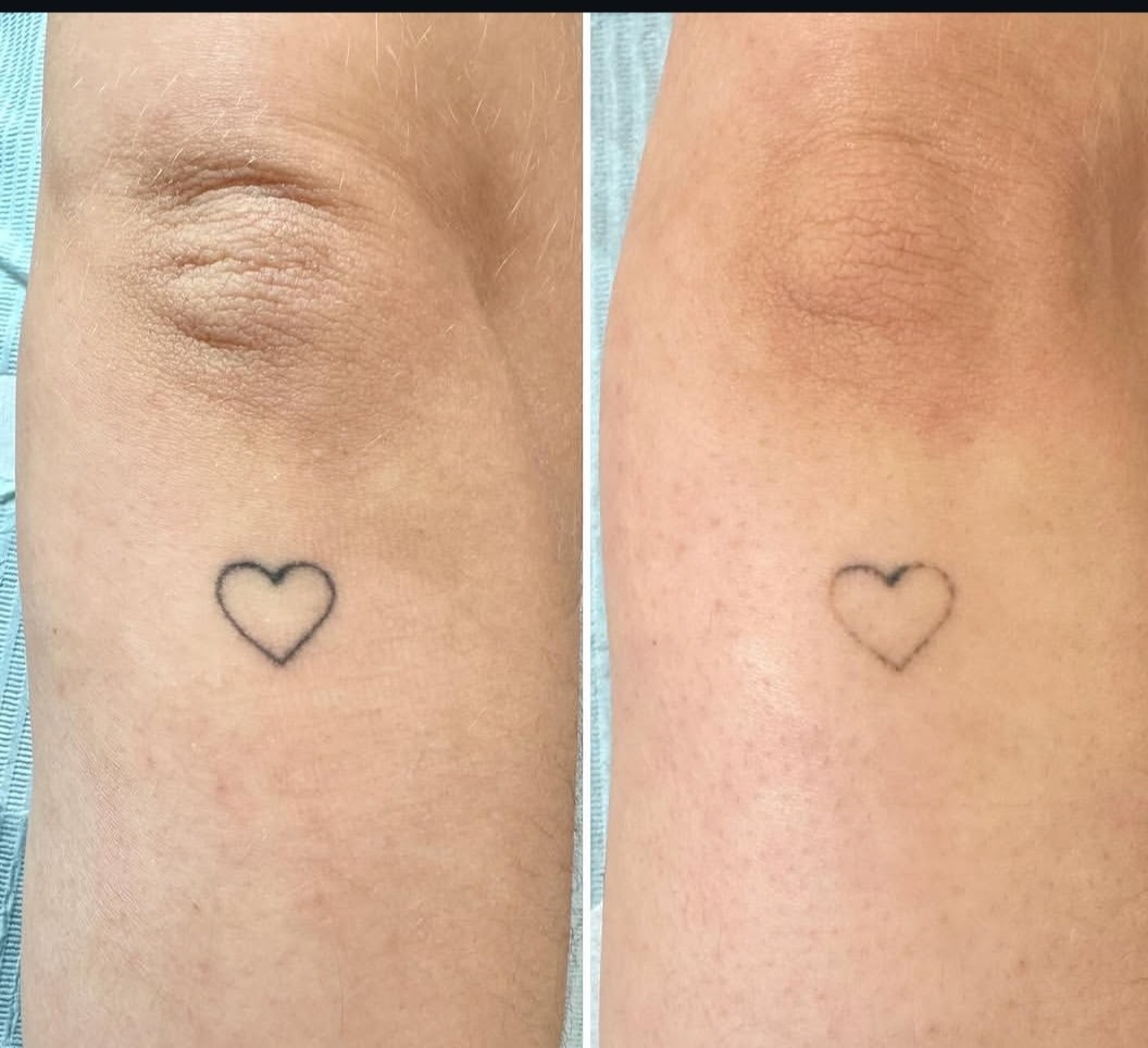 Before and after of a small heart tattoo faded with saline removal