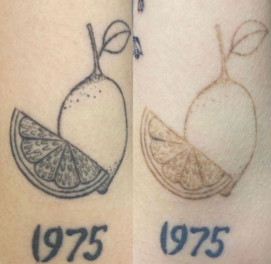 Before and after of a lemon tattoo faded with saline removal