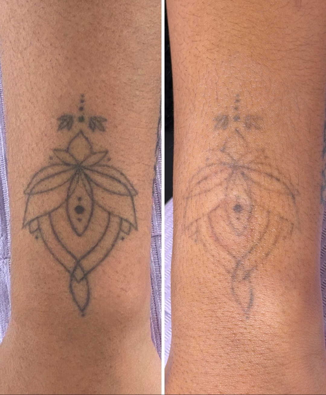 Before and after of a lotus tattoo on the ankle faded with saline removal