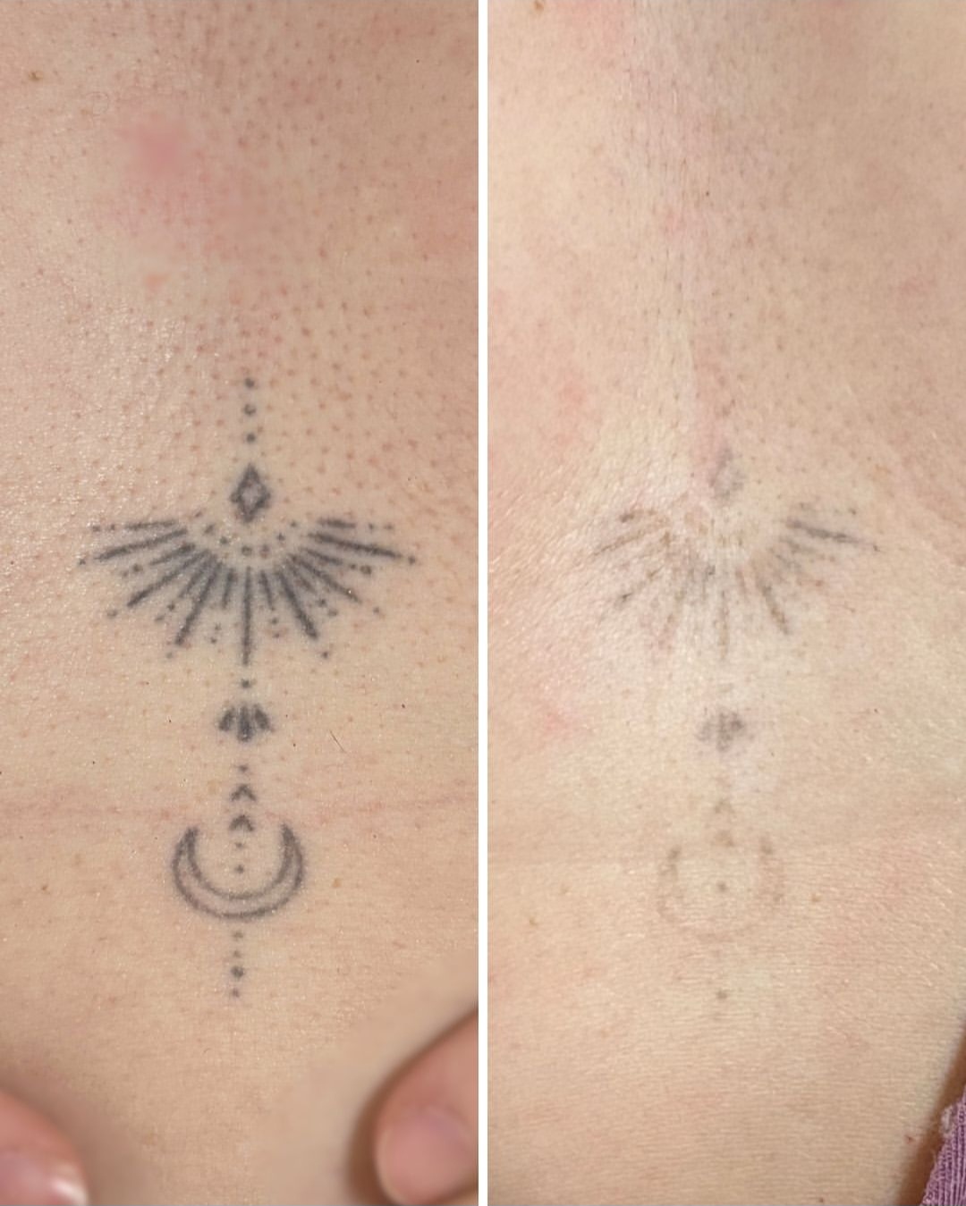 Before and after of a mandala sternum tattoo faded with saline removal
