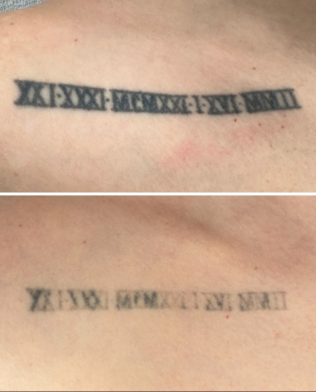 Before and after of a roman numeral tattoo on the collarbone faded with saline removal